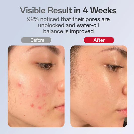 Acne & Wrinkle Reducing 7 Color LED Therapy Mask